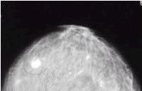 Mammografie: Brustkrebs (heller Bereich) in einer Aufnahme von oben