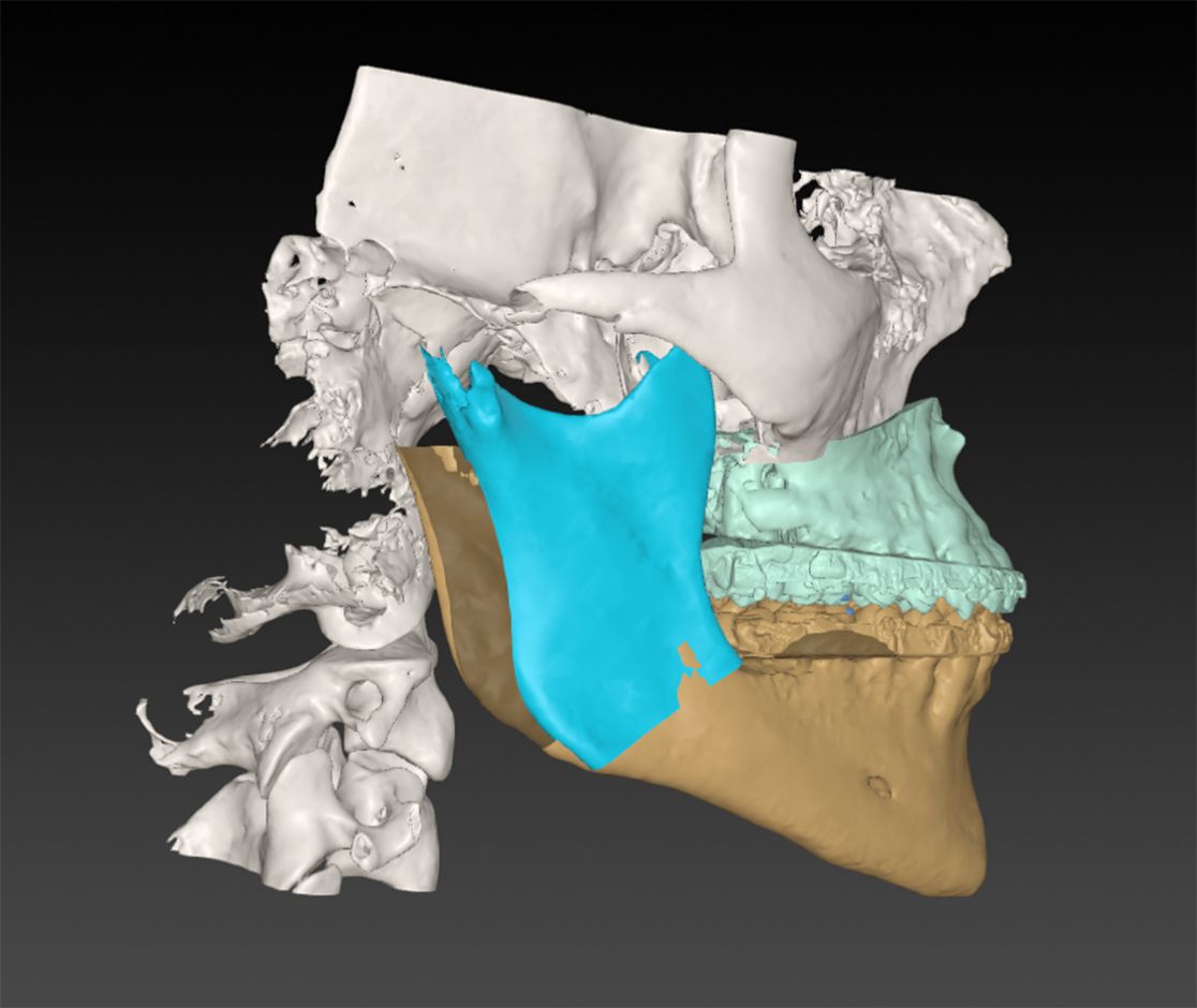 3D Darstellung eines Kiefers mit behandelter Dysgnathie