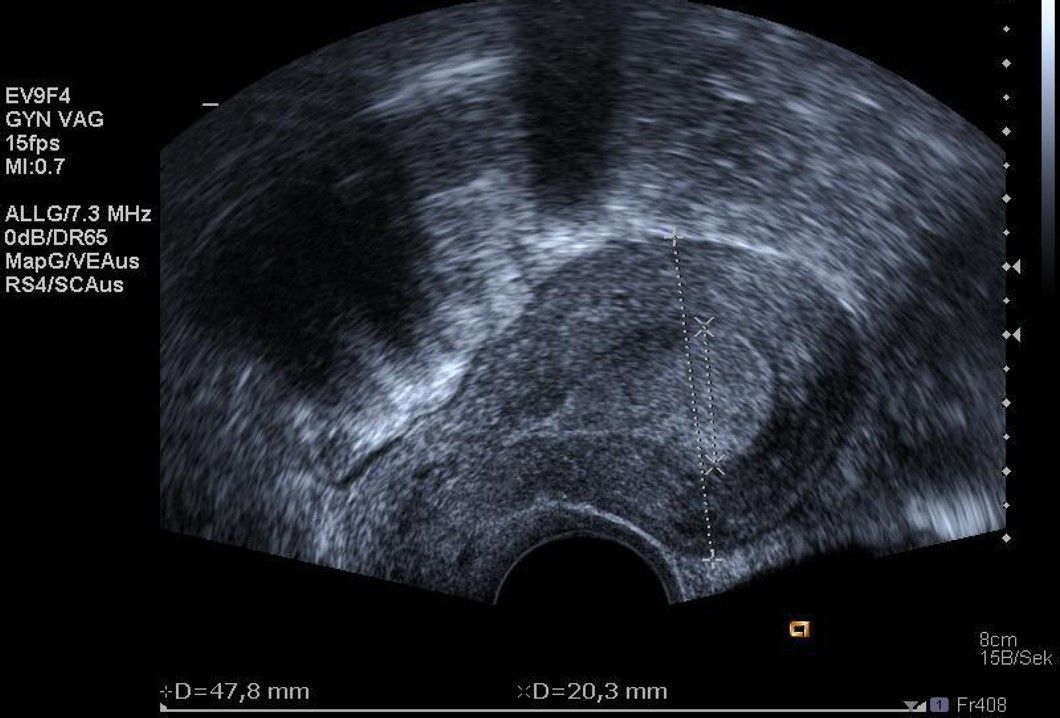 Abb. 1: Ultraschalldarstellung eines submukösen Myoms (unter der Gebärmutterschleimhaut)