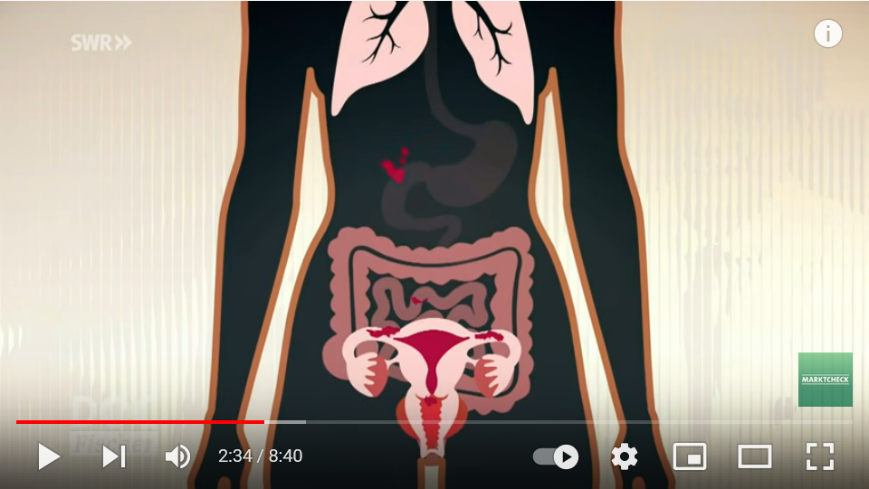 Headerbild Video: Grafik zeigt Endometrioseherde im Körper