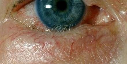 Einwärtsdrehen des Unterlides (Entropium) mit unangenehm reibenden Wimpern auf dem Auge