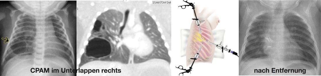 Lungenchirurgie: Abb. links: CPAM im Unterlappen rechts. Abb. rechts: nach Entfernung