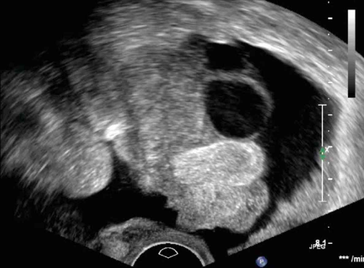 Schwangerschaft ohne ultraschall gebärmutter Schwanger ohne