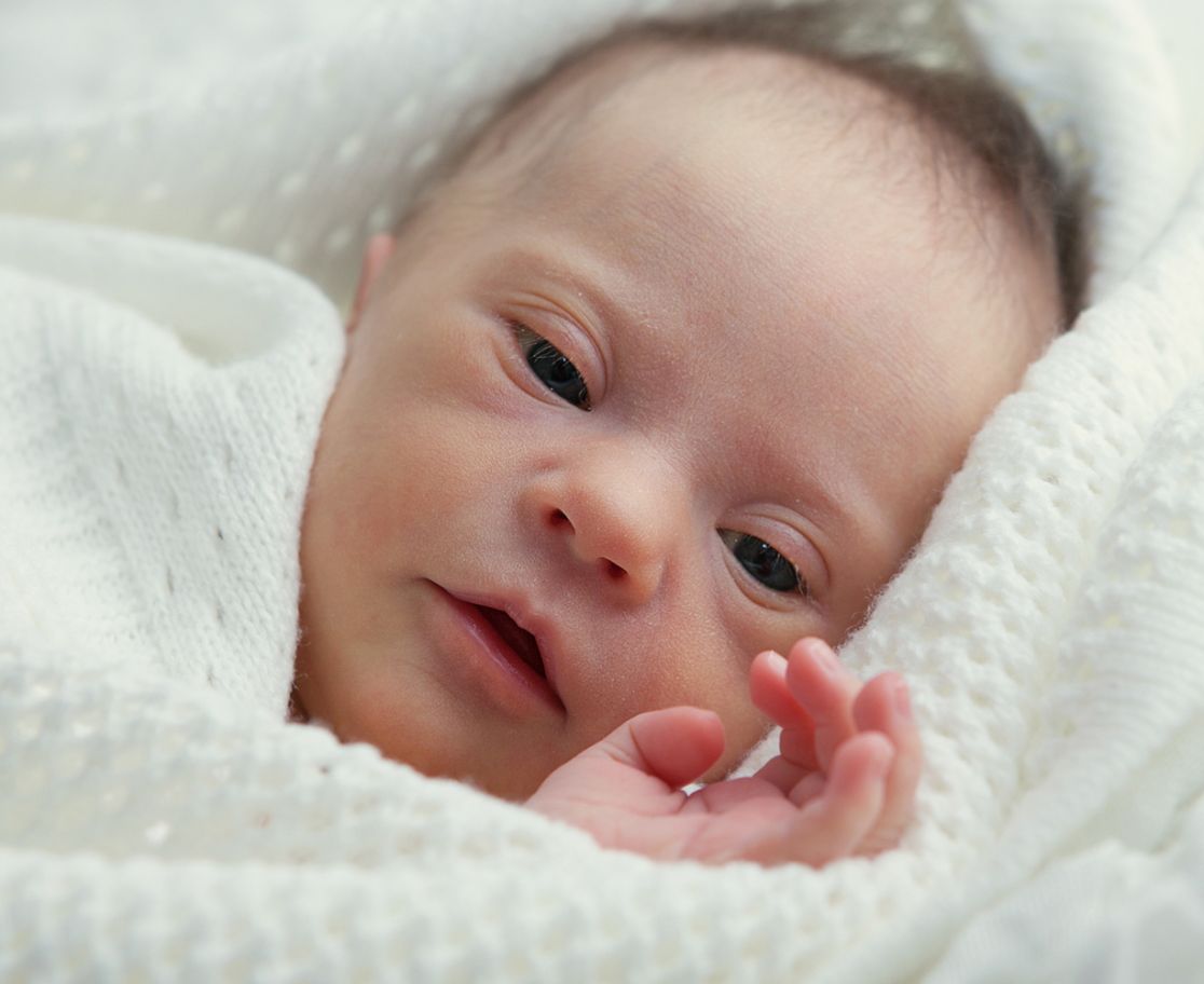 Baby mit Down Syndrom