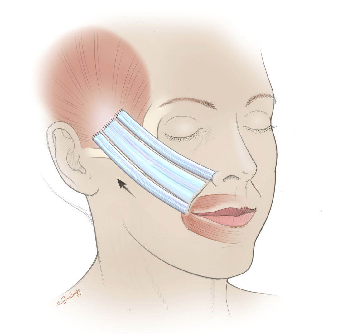 Abbildung 6: Zügelplastik mit Fascia lata mit drei Ankerpunkten (Nasenflügel, Nasolabialfalte und Mundwinkel)