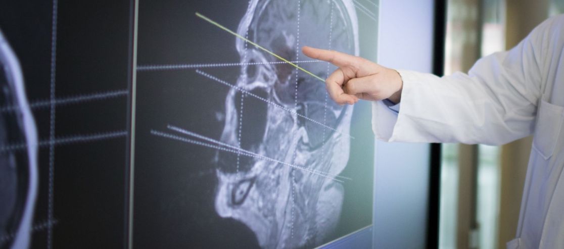 Schmuckbild: Person zeigt auf CT-Scan eines Gehirns