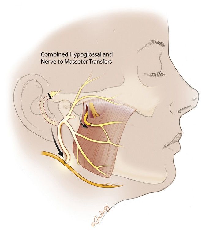 Abbildung 4: Kombination aus Hypoglossus- und Massetericus-Transfer für unterschiedliche Gesichtspartien