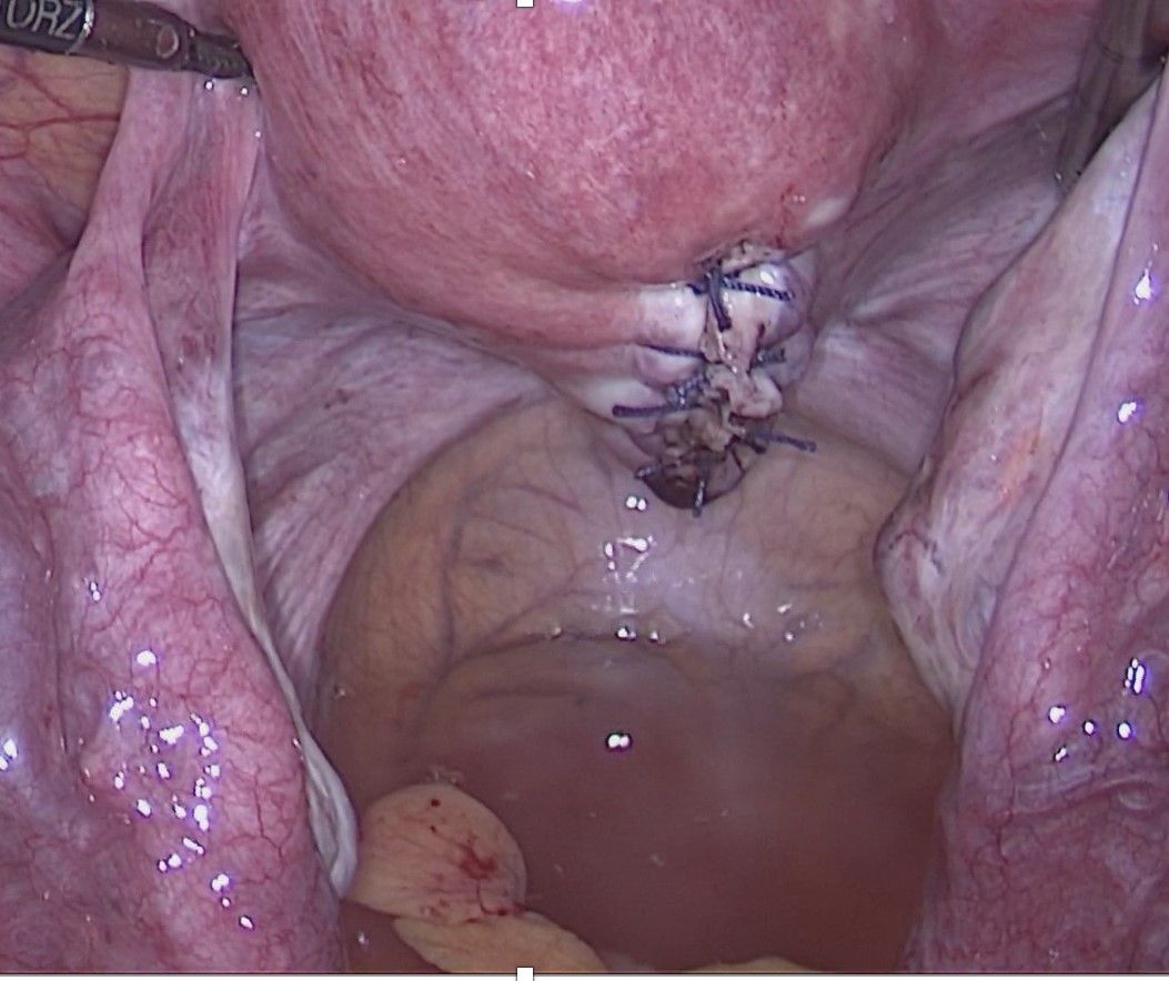 Abb.7: Sicht Gebärmutterhinterwand nach Entfernung des Myoms per Bauchspiegelung (Laparoskopie) mit Naht der Gebärmutter