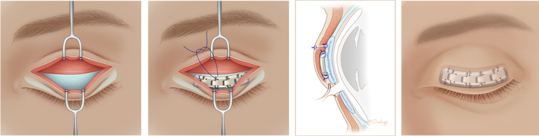 Abbildung 7: Implantation einer Platinkette ins Oberlid (Schritt für Schritt)
