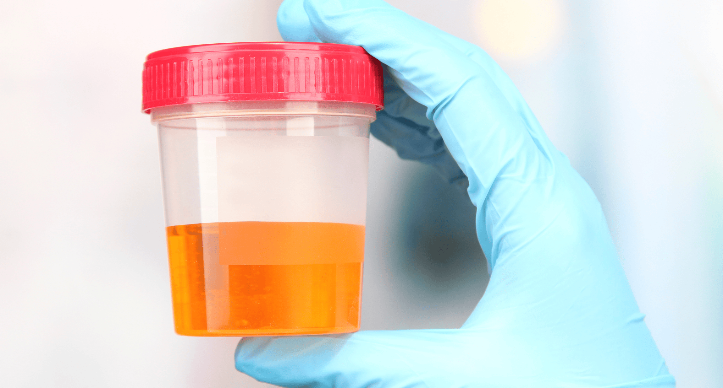 Blut im Urin ‒ was man tun sollte